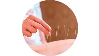 Acupuntura